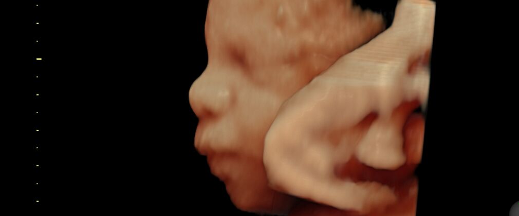 3D scanning af baby hos Under mit hjerte