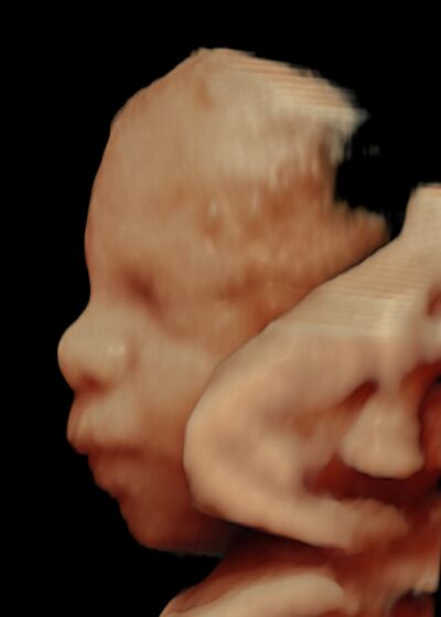 3D scanning af baby hos Under mit hjerte